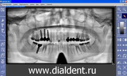 Imagine panoramică digitală a dinților