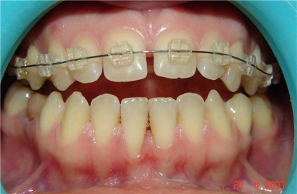 Diastema cauzei, tratamentul diastemului, foto, medicul dentist