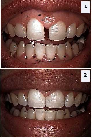 Az okmány diastema, diasztéma kezelés, fotó, fogorvos