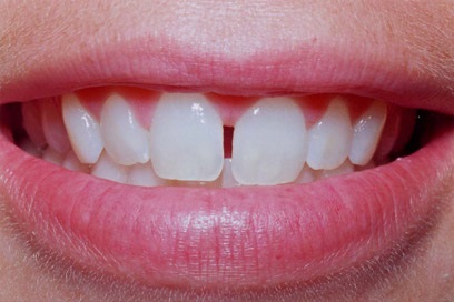 Diastema cauzei, tratamentul diastemului, foto, medicul dentist