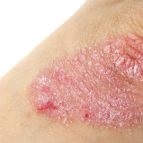 Eczemele pe spate provoacă, simptome și tratament