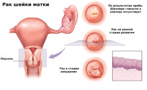 Eroziunea și cancerul de col uterin pot deveni boala într-o oncologie, există grupuri de risc