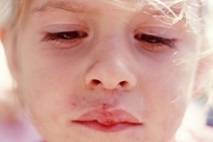 A herpesz a gyermekeknél - egy egyszerű hideg a suzsik ajkán