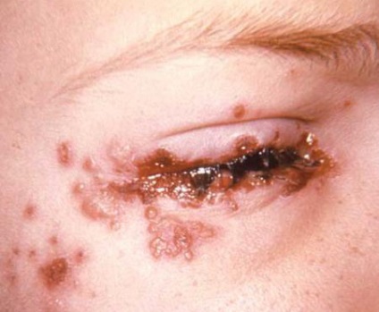 Herpesul la copii - o răceală simplă pe buzele znaike