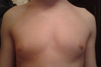 Gynecomastia tinédzserek tünetei, okai, diagnózisa és kezelése