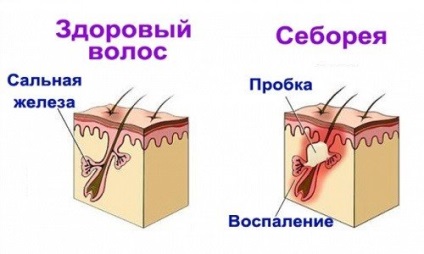 A bőr gombája (mycosis) a testen - kezelés, fotók és tünetek