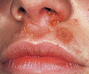 Impetigo la copii și adulți cauze, tratament, complicații, prevenire