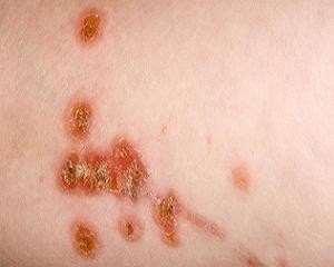 Impetigo la copii și adulți cauze, tratament, complicații, prevenire