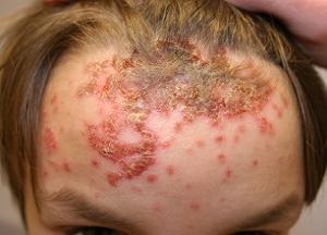 Impetigo la copii și adulți cauze, tratament, complicații, prevenire