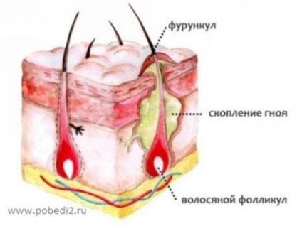 Ce remedii naturale de utilizat pentru furunculoză