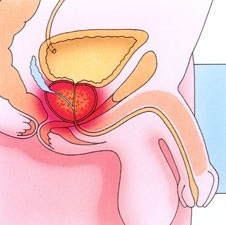 Cum sunt legate prostatitele și alcoolul?