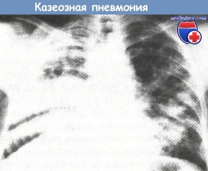 Pneumonie pneumatică - clinică, diagnostic
