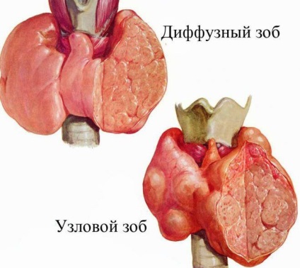 Chistul glandei tiroide - cod pentru μb-10