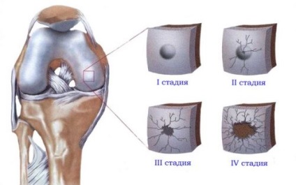 Exerciții de fizioterapie pentru artroza articulației genunchiului