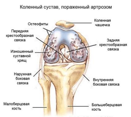 Exerciții de fizioterapie pentru artroza articulației genunchiului