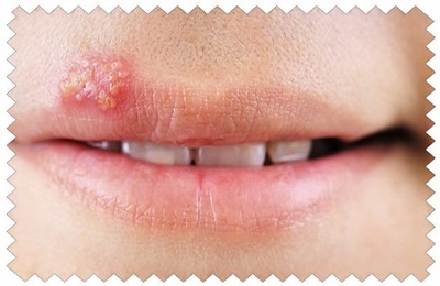 A herpesz kezelése az ajkán, és hogyan lehet megszabadulni és hatékony eszközökkel