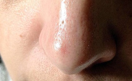 Tratamentul porilor dilatați pe față