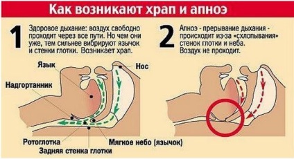 Tratamentul sforăitului - clinica UT Ulyanovsk