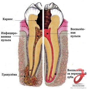 Tratamentul canalelor dentare - o descriere a serviciului, prețuri, recenzii în Sankt Petersburg