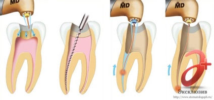 Tratamentul canalelor dentare - o descriere a serviciului, prețuri, recenzii în Sankt Petersburg