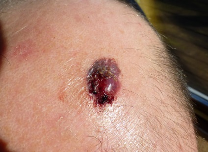 A bőr melanoma okozza, tünetei, kezelése