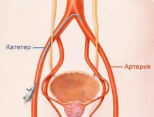 Metode de tratament al adenomului de prostată și recomandări generale la pacienți