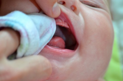 Miros neplăcut din gură la nou-născut și sugari
