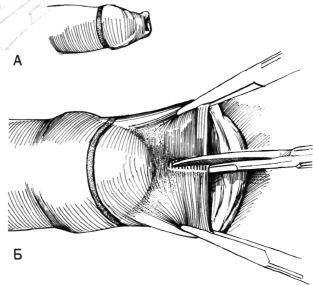 Circumcizia cu ajutorul dispozitivului plasticella, hyman f