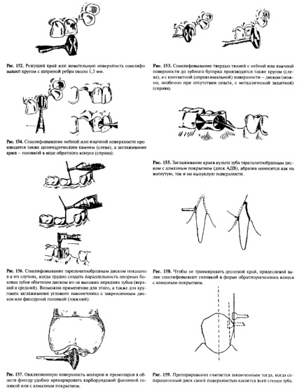 Principii generale de pregătire pentru coroane artificiale - un bun portal dentar, bun