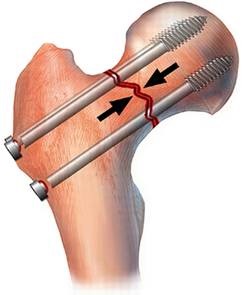Tratamentul operativ al fracturii de șold a proeminenței femurului
