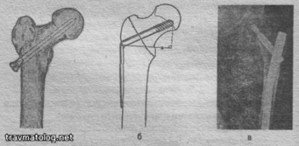 A combcsont proximális töréseinek osteosynthesis