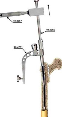 Osteosinteza femurului proximal