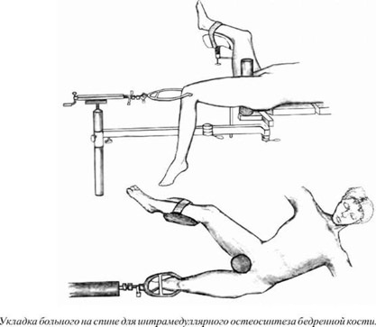 Osteosinteza femurului proximal