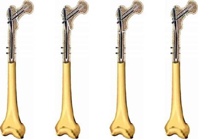 Osteosinteza femurului proximal