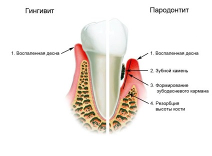 Simptome și tratament al parodontitei, foto