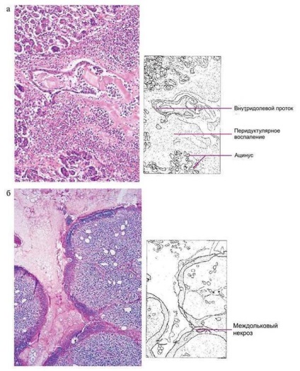 Pathomorfologia pancreatitei