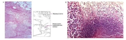 Pathomorfologia pancreatitei