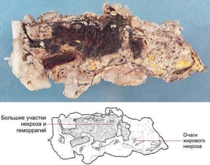 Pathomorfologia pancreatitei