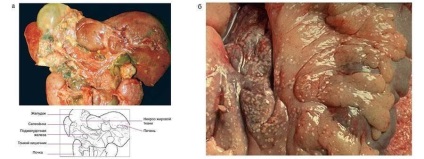 Pathomorfologia pancreatitei