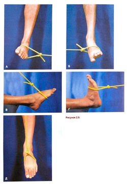 Anterior tibialis szindróma