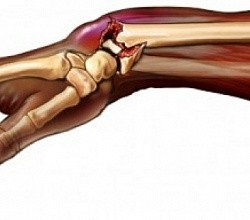 Fractura simptomelor bratului (semne) și tratamentul fracturilor deschise ale oaselor brațului, online sănătoase