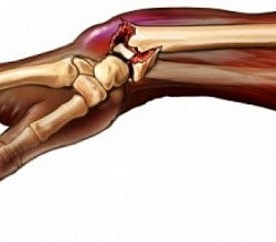A kar tüneteinek törése (jelek) és a karcsontok nyitott törése kezelése, egészséges online