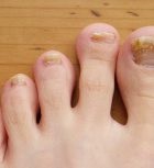De ce unghiile galbene provoacă apariția petelor galbene și tratamentul lor