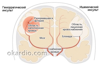 A jobb oldali hemorrhagiás stroke következményei, hányan élnek