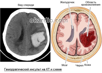 A jobb oldali hemorrhagiás stroke következményei, hányan élnek