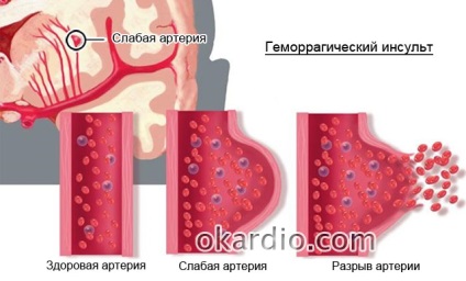 A jobb oldali hemorrhagiás stroke következményei, hányan élnek