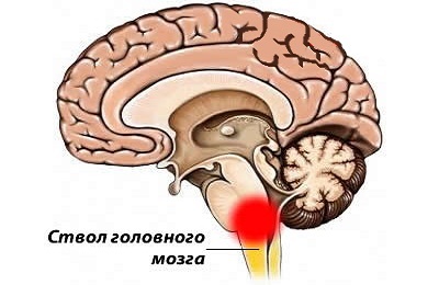 Consecințele accidentului cerebral ischemic