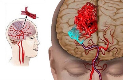 Consecințele accidentului cerebral ischemic