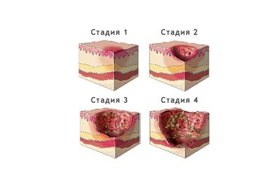 Consecințele accidentului cerebral ischemic