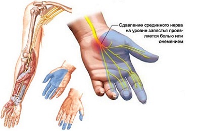 Consecințele accidentului cerebral ischemic